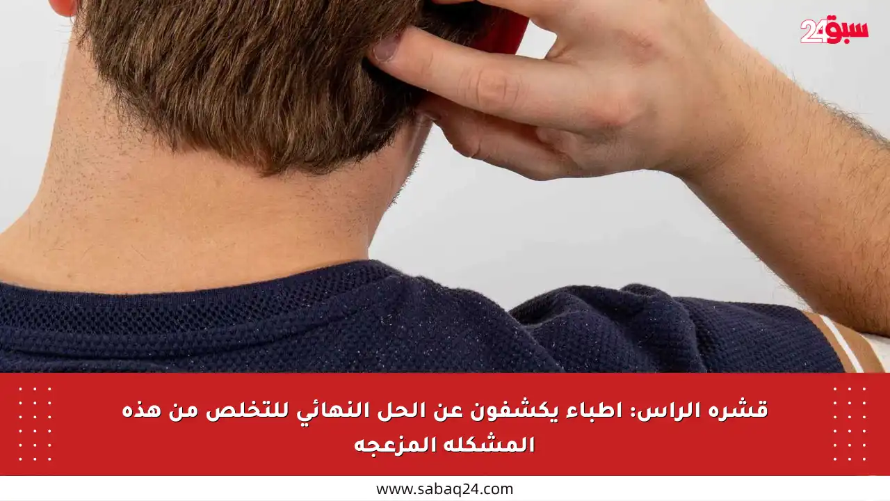 قشرة الرأس: أطباء يكشفون عن الحل النهائي للتخلص من هذه المشكلة المزعجة